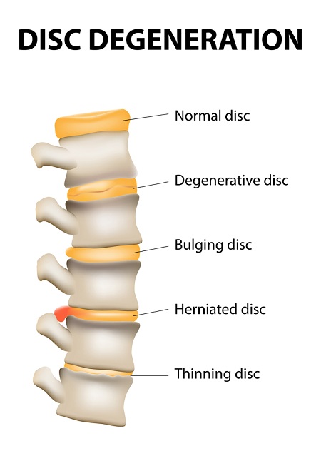 disc degeneration in lower back
